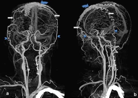 Cirsoid Aneurysm Of Scalp Demonstration On Ct Angiography Cta Bmj