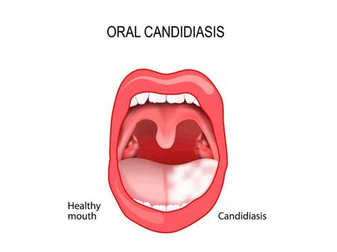 The Pathophysiology Of Oropharyngeal Candidiasis Treating Fungus