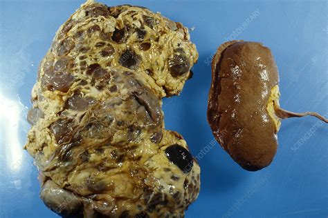 Human Kidneys Stock Image M1950133 Science Photo Library