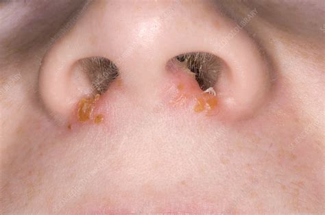 Impetigo Infection On Nose Stock Image M1800150 Science Photo