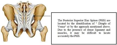 Posterior Superior Iliac Crest