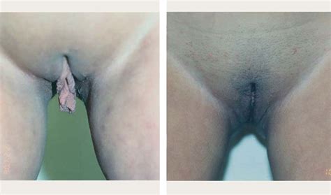 Labiaplasty Before And After