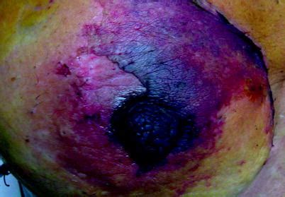 In this video i will be discussing about necrosis, its causes, characteristic features & various types in detail along with pictorial representation. Nipple-Sparing Mastectomy with Electron Intraoperative ...