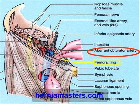 Surgical Anatomy Femoral Sheath Canal Ring The And Wwsurgical Anatomy The Femoral Canal