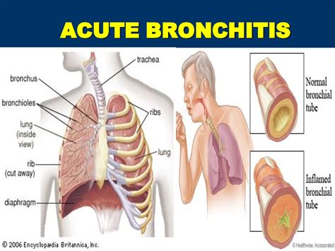 Acute Bronchitis Faqssigns Of Acute Bronchitis How To Heal It