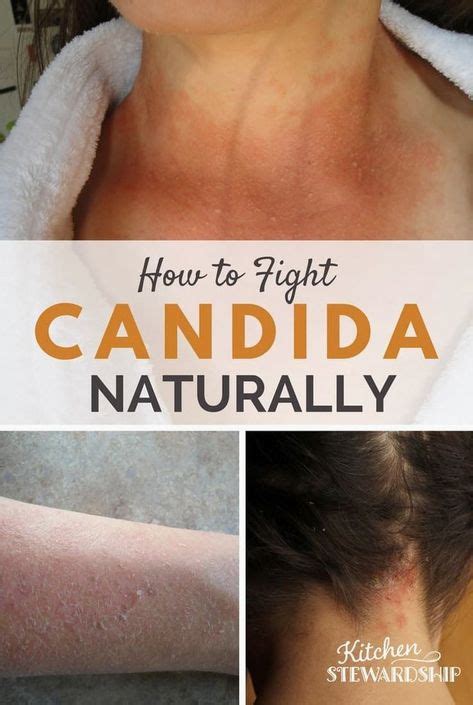 Natural Home Remedies For An Itchy Candida Skin Rash Including Foods