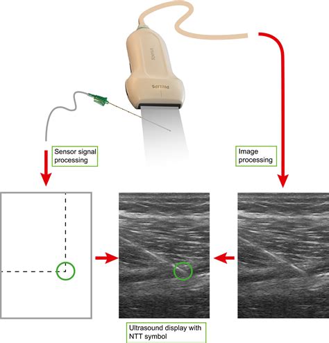 Needle Tip Tracking For Ultrasound‐guided Peripheral Nerve Block