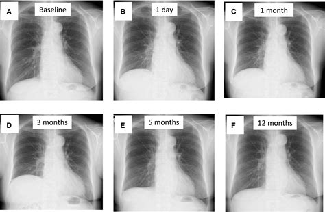 Characteristics Of Phrenic Nerve Injury During Pulmonary Vein Isolation