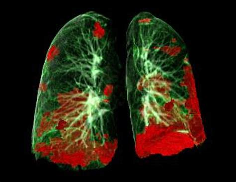 Covid 19 Patients Suffer Long Term Lung And Heart Damage But They Can