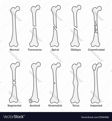 Types Of Bone Fractures Medical Educational Vector Stock Vector Image