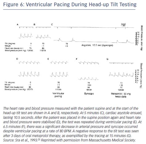 Figure 6 Ventricular Pacing During Head Up Tilt Testing Radcliffe