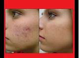 Skin Discoloration After Laser Treatment Images