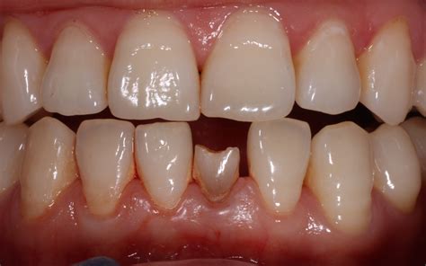 Retained Milk Tooth Photos Dental Implants Dental Implants