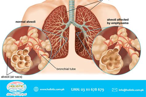 Chronic Obstructive Pulmonary Disease UAN 03111678679