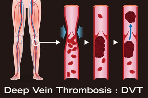 Deep Vein Thrombosis Dr Toby Cohen