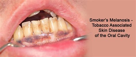 Smoking And Its Effect On Skin
