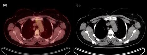 Petct Fusion And Axial Ct Images Reveal A Lymph Node With Increased