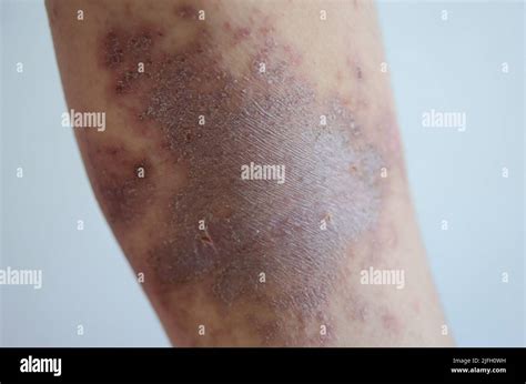 Red Rash Girl Skin Disease Caused By Allergies To Drugs Food