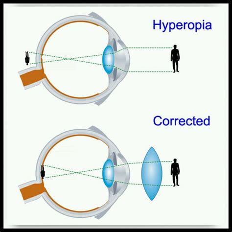 Make A Diagram To Show How Hypermetropia Is Corrected The Near Point Of
