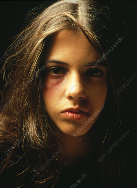 Teenage Girl With A Black Eye And Facial Bruising Stock Image M3300767 Science Photo Library