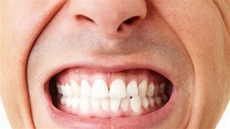Boca Masculina Rangendo Os Dentes Vittal Clínica Odontológica No