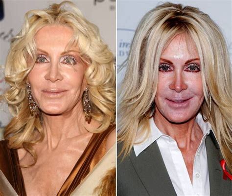 When Weekend Plastic Surgery Goes Horribly Wrong Pics Club Giggle
