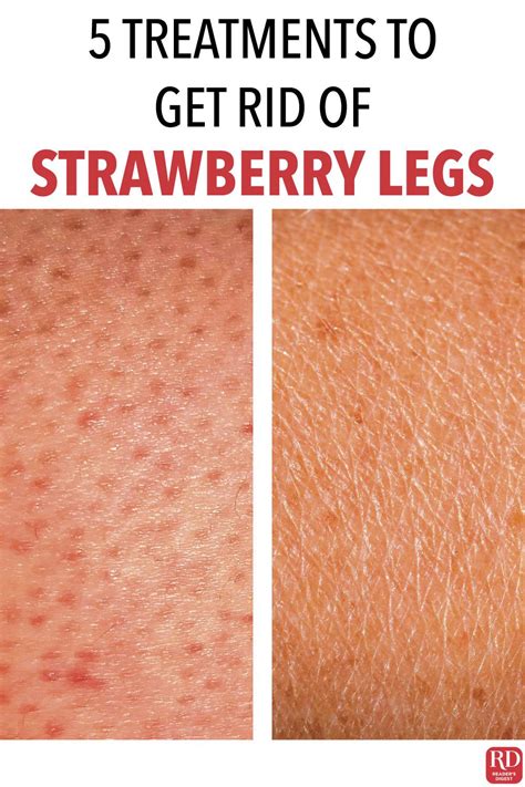 How To Get Rid Of Strawberry Legs 5 Treatments That Work In 2020