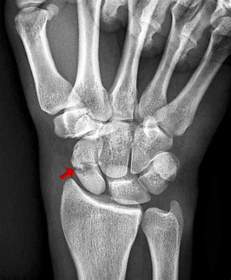 Scaphoid Navicular Fractures Injuries Poisoning Msd