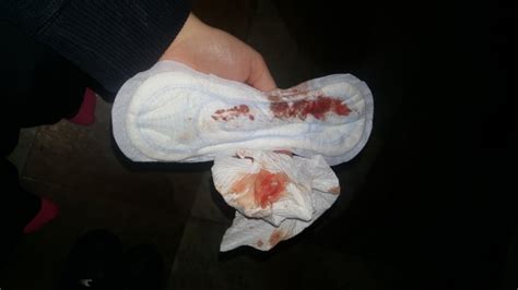 Does this look like implantation bleeding? PLEASE HELP! (TMI PHOTOS) Implantation Bleeding? Or just ...