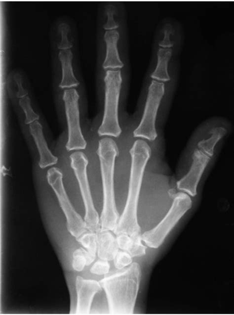 Hand Wrist Radiograph Showing Osteophytes And Mineralization Of