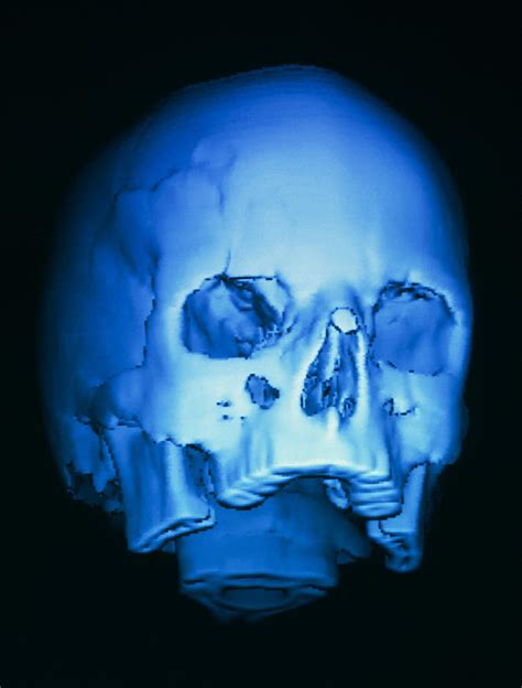 3 D Ct Scan Of Skull With Fracture Above Eye Photograph By