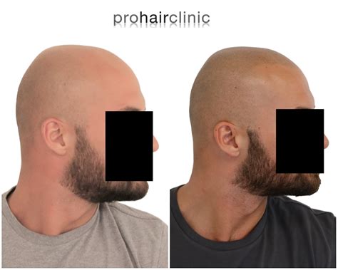 Ein haartransplantation forum bietet personen, die an einer haartransplantation interessiert sind oder den eingriff bereits durchgeführt haben, die möglichkeit eines austausches. Haartransplantation Forum : Alternativen / Ergänzungen (z ...