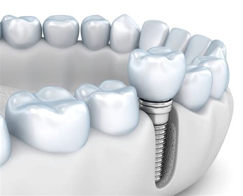 Dental Implants Dentist In Chicago Il Premier Dentistry