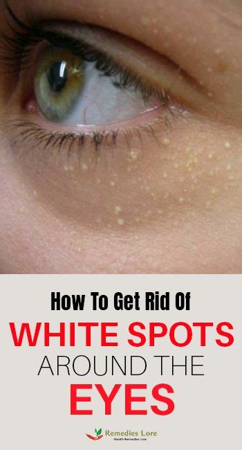 How To Get Rid Of White Spots Around The Eyes Whitespots Eyes Spots