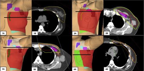 A Clinical Perspective On Regional Nodal Irradiation For Breast Cancer