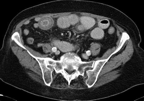 Axial Image Of Contrast Enhanced Ct Of The Abdomen And Pelvis There Is