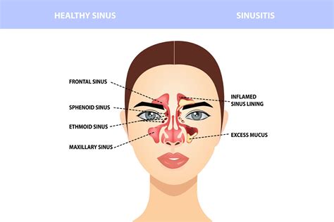 Sinus Causes And Symptoms Meril Life