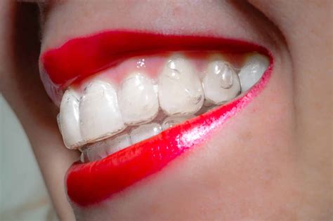 Invisalign Before And After 6 Things You Should Know Carolina Smiles
