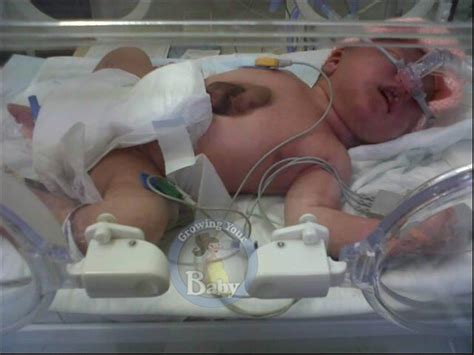 Little Fighter Born With Heart Outside Her Body Growing Your Baby