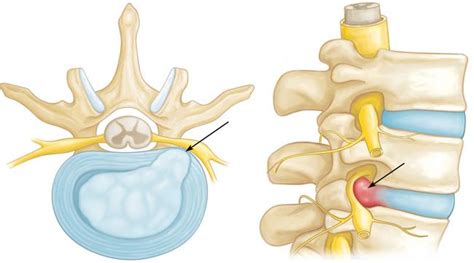 Cervical Radiculopathy Download Scientific Diagram