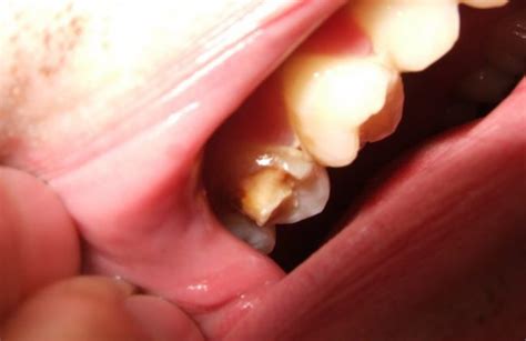 10 Home Remedies To Stop Broken Tooth Pain