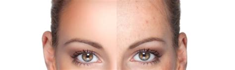 Hyperpigmentation Treatments London Eudelo Clinic
