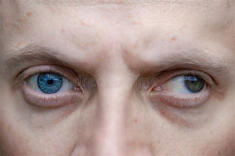 Full Face Close Up Photo Of A Man With Strabismus And Blindness Of One