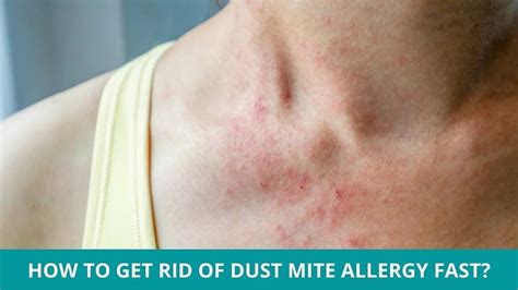 How To Get Rid Of Dust Mite Allergy Fast