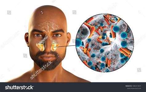 Sinusitis Inflammation Paranasal Cavities 3d Illustration Stock