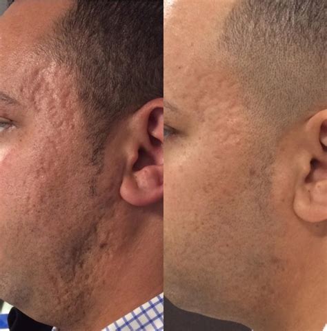 Microneedling Before And After Photo Gallery Sacramento Ca