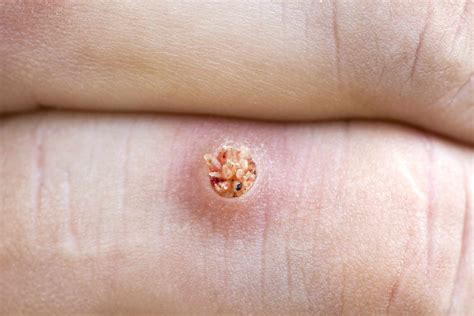 Warts Types Symptoms Causes Treatment And More