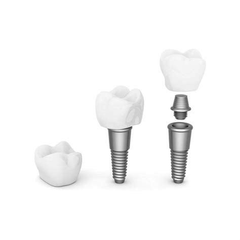 Implante Dental De Titanio Al Mejor Precio