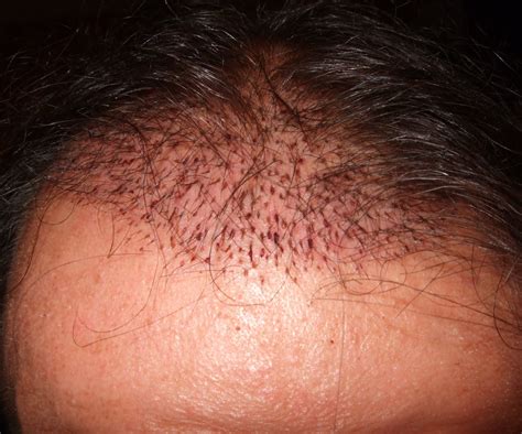 I often get one or sometimes two tender spots on my forehead, just above my eyebrows with some edema. HAIR TRANSPLANT