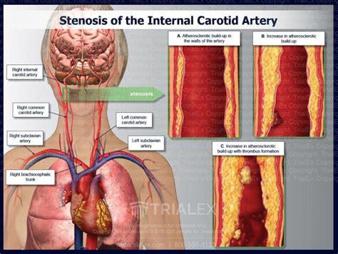 Progression Of Stenosis Internal Carotid Artery TrialExhibits Inc